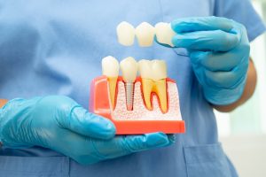 Dentist holding dental crown model showing tooth replacement and implant structure for decay prevention.