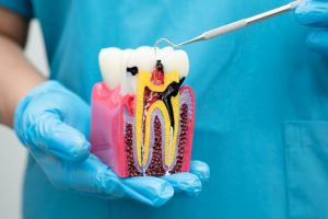 Dental cross-section model showing tooth anatomy with decay and nerve damage requiring root canal treatment.
