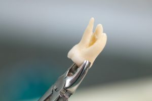 Dental extraction tool holding a bone graft material used in tooth removal recovery procedures.