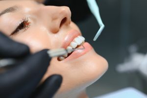 Patient receiving professional teeth whitening treatment during cosmetic dental procedure.