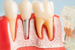 Dental implant model showing tooth replacement next to natural teeth and gum tissue.