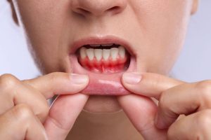 Close-up of inflamed gums and lower lip showing redness and swelling in mouth.
