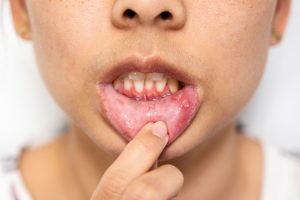 Child pointing to red, inflamed canker sore on lower gum and tongue area.