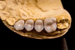 Porcelain vs Zirconia vs Metal Crowns